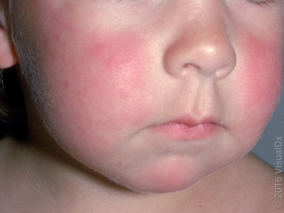 Close-up of a child's face with red cheeks in fifth disease (slapped cheek) rash. 