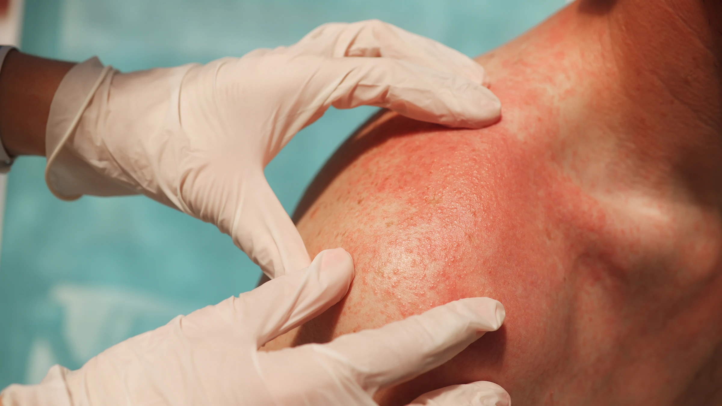 glutathione side effects rashes Drug Rashes: 7 Medications That Can Cause Skin Reactions Bisphenol AF (BPAF) jeopardizes