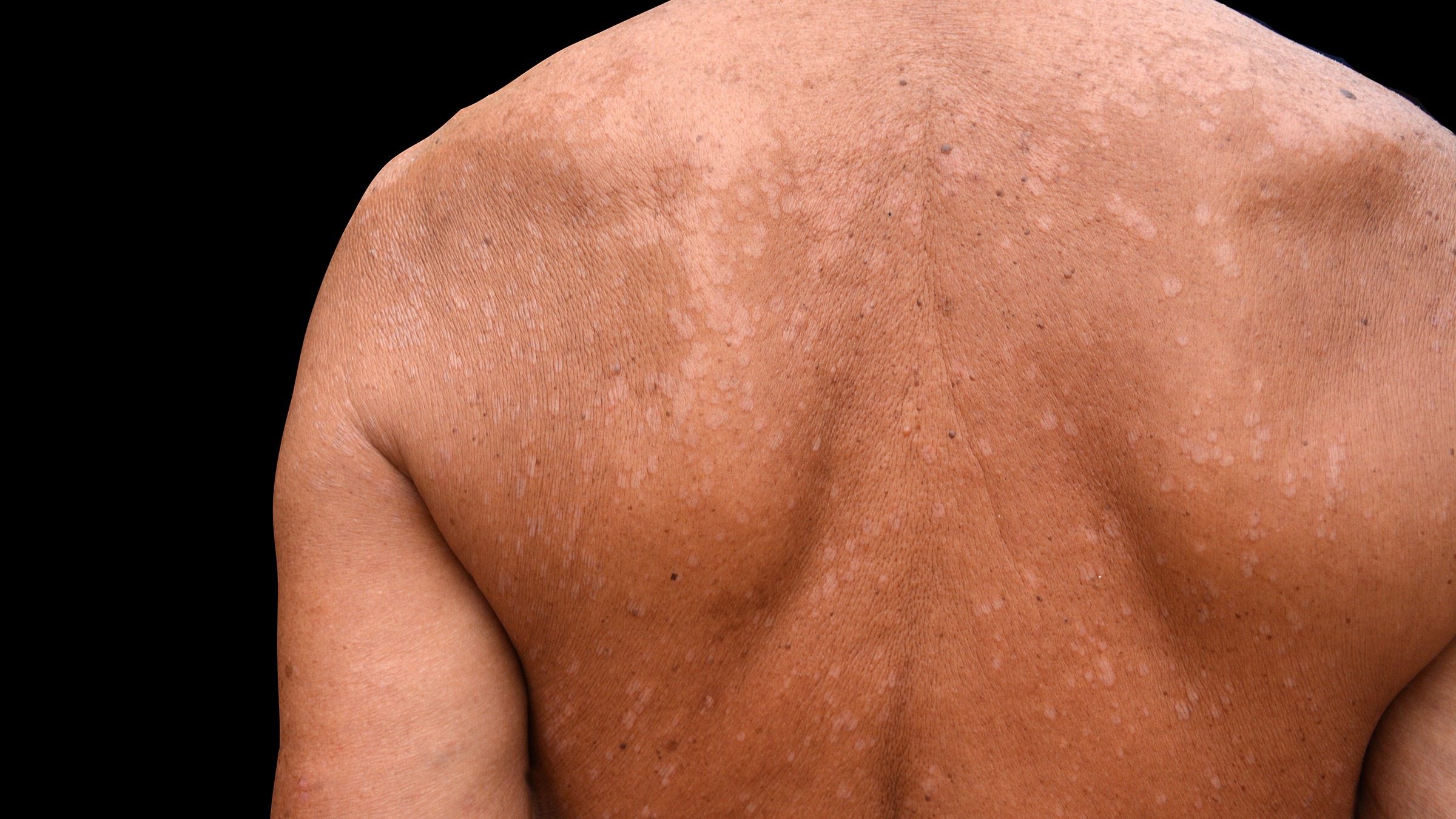 Medical: Tinea versicolor is a condition caused by the Malassezia