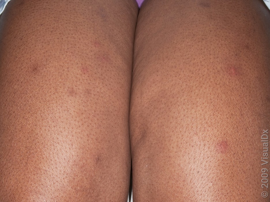 Bedbug bites on darker skin tones can leave dark marks when they heal.