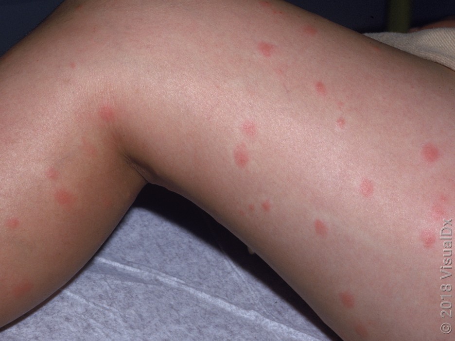 Many scattered, round, red bumps on the leg in swimmer’s itch. 