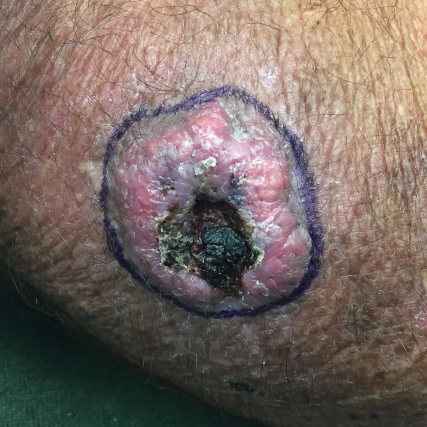 A close-up image shows a squamous cell carcinoma with central crater in a light skinned person.