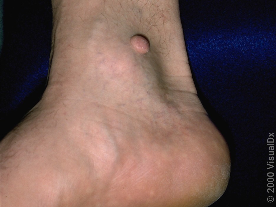 A dome-shaped dermatofibroma on the ankle.