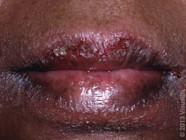 Sore Dry Lips Causes And Remescar Review Infoupdate