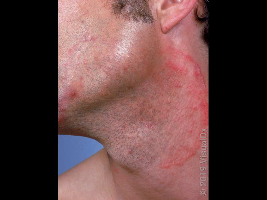 Close-up of ringworm in the beard area (tinea barbae).