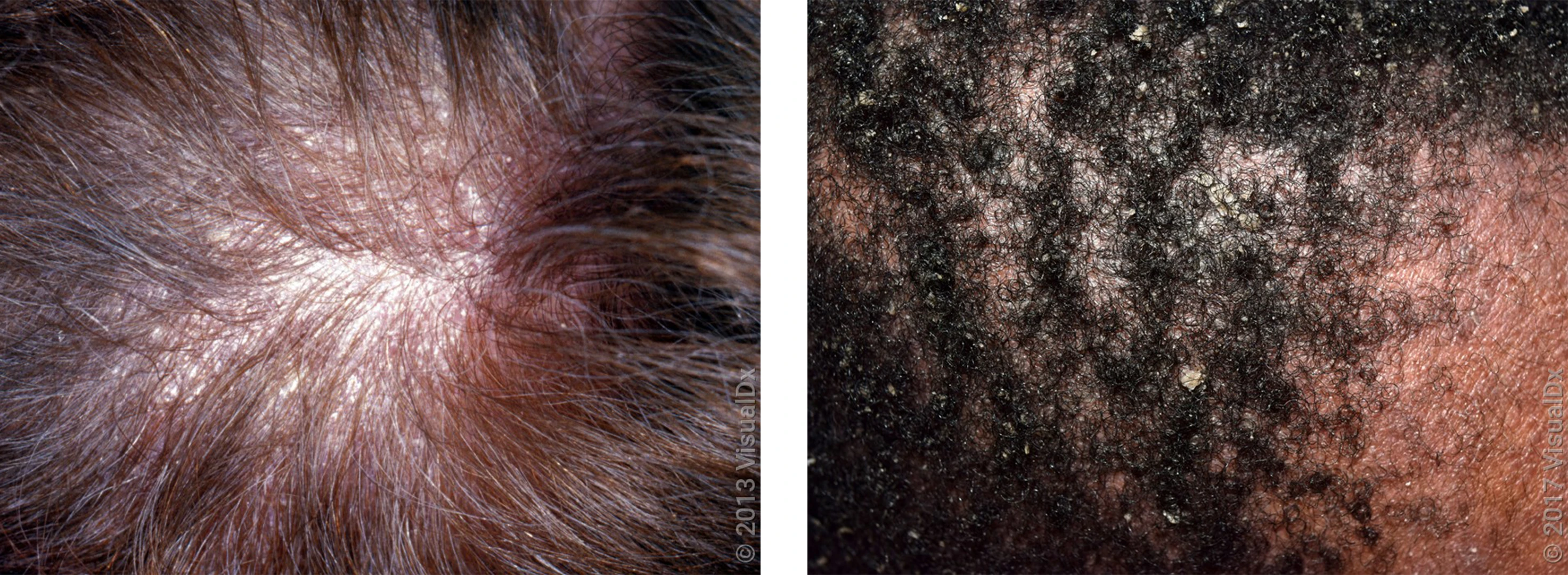 Left: Close-up of scalp hairs that have white flakes (dandruff). Right: Close-up of frontal hairline with mild flaking and lighter patches of skin (dandruff).