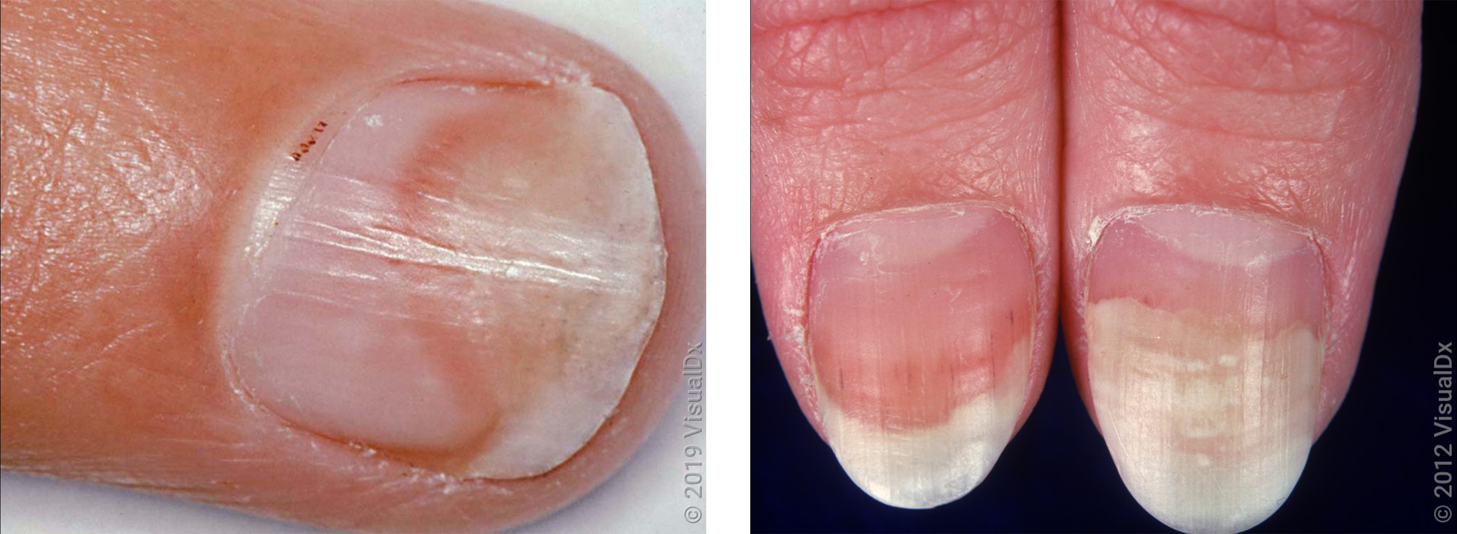 Evaluation of nail lines: Color and shape hold clues | Cleveland Clinic  Journal of Medicine