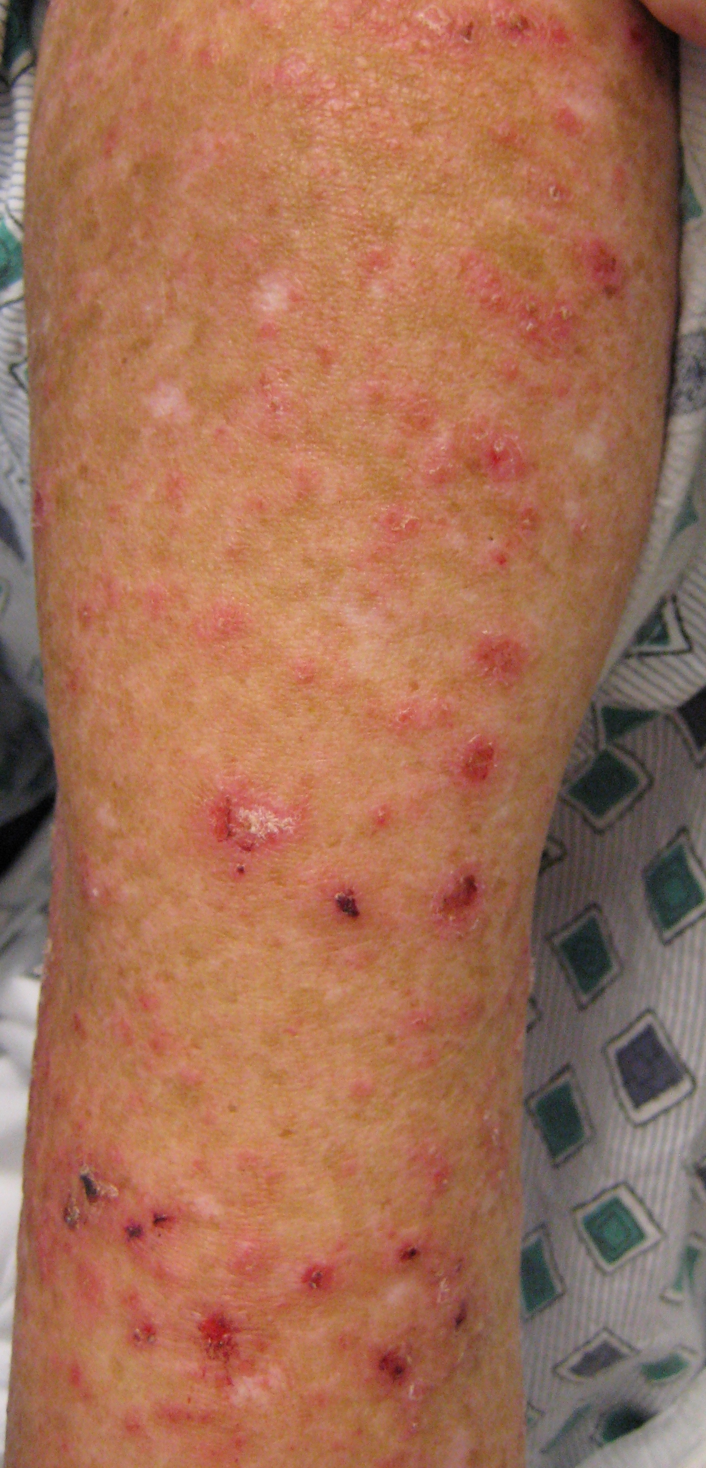 rosacea on upper arms
