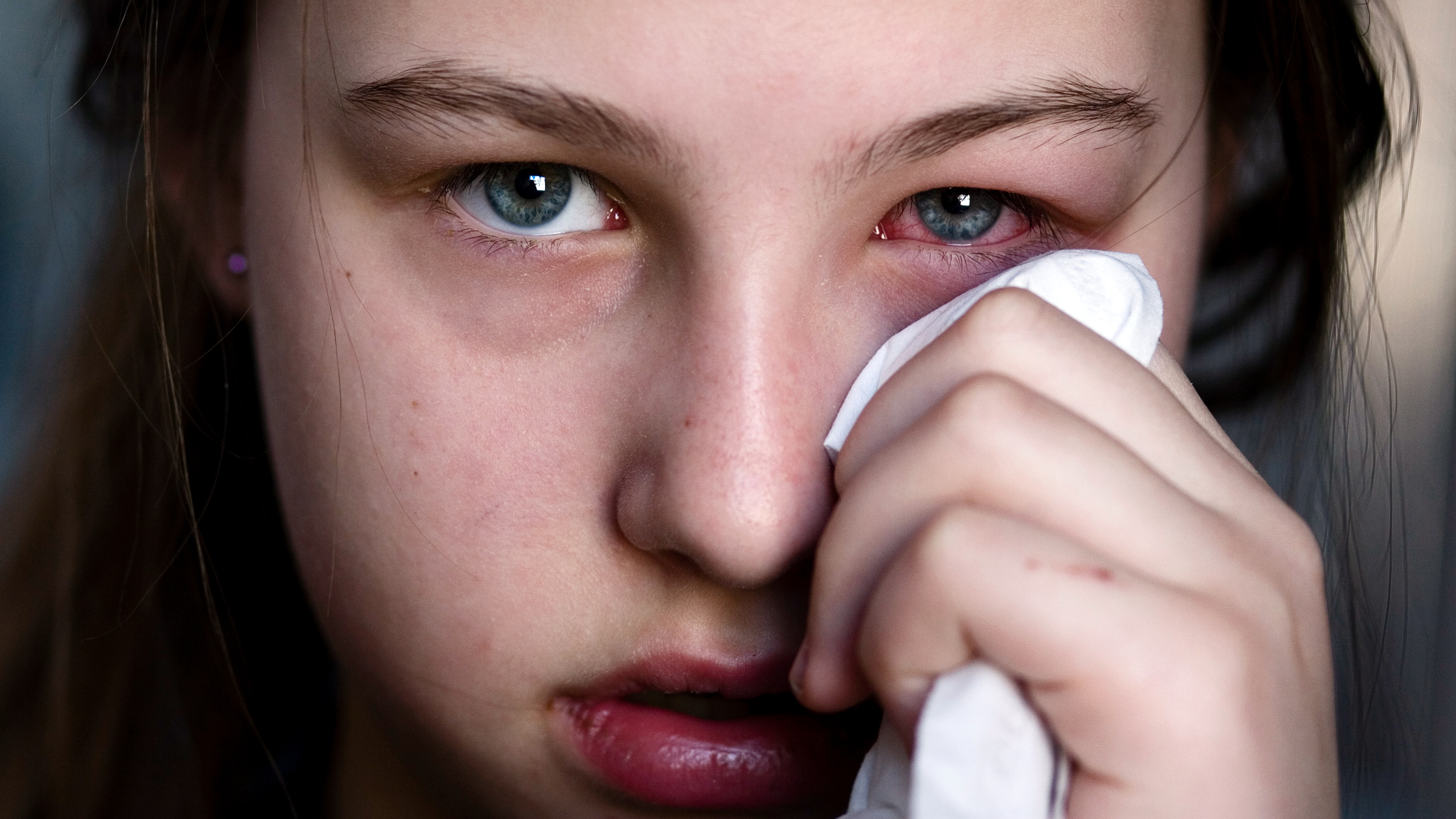 How long does pink eye last? 7 signs you are still contagious