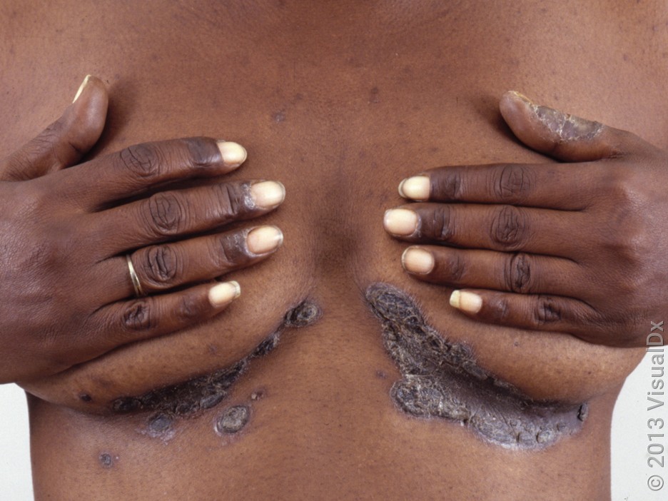 Close-up of a chest with thick, dark-brown, scaly patches under the breasts in inverse psoriasis. 