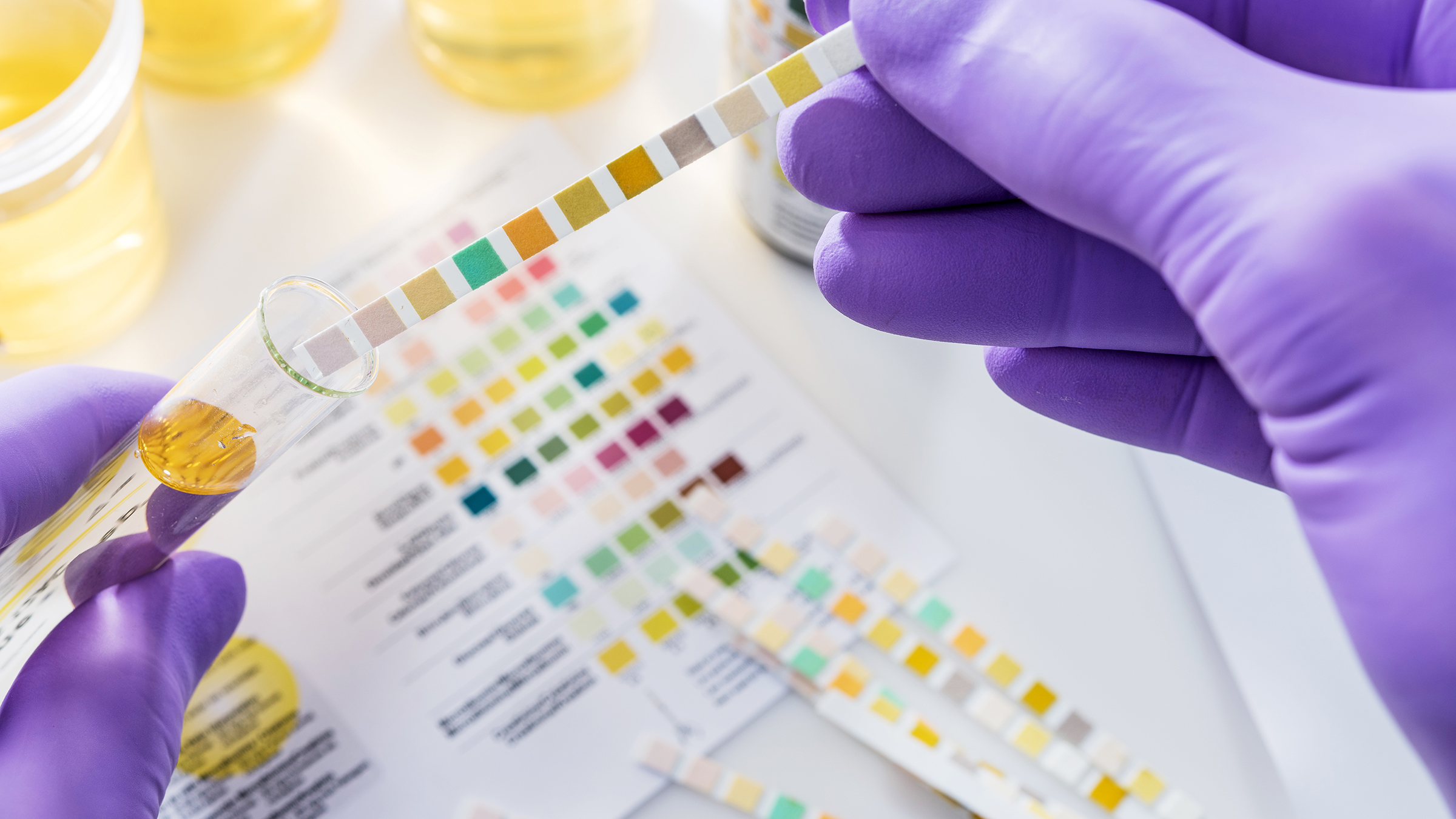 Gloved hands are holding a urine test strip.
Lothar Drechsel/iStock via Getty Image Plus