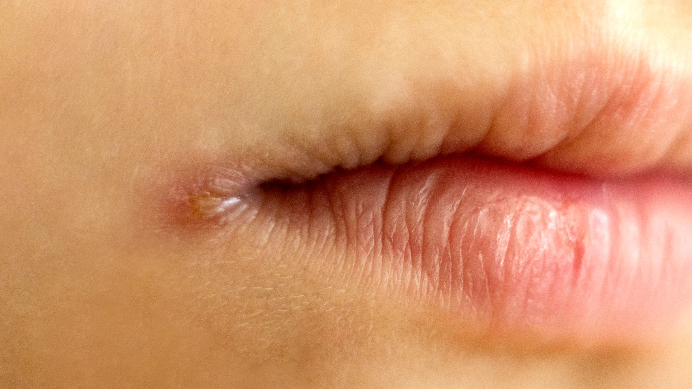 angular-cheilitis-symptoms-treatment-images-goodrx