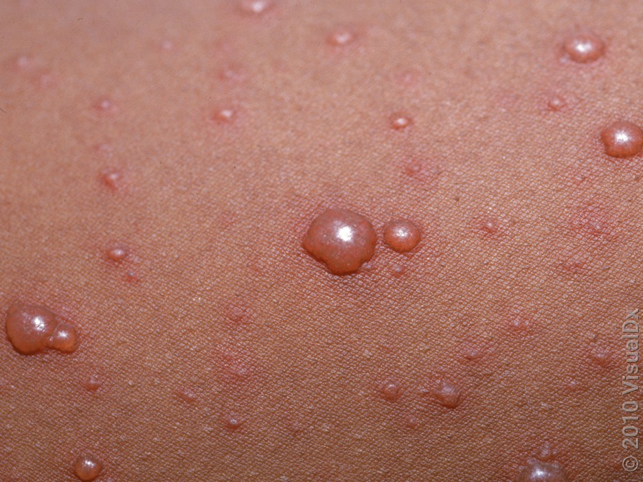 Chickenpox vs. Bug Bites: How to Tell the Difference - GoodRx