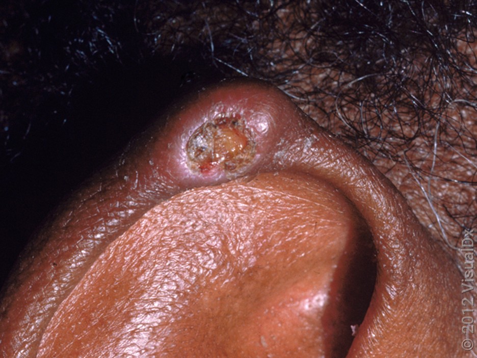 A single tophus on the ear. 