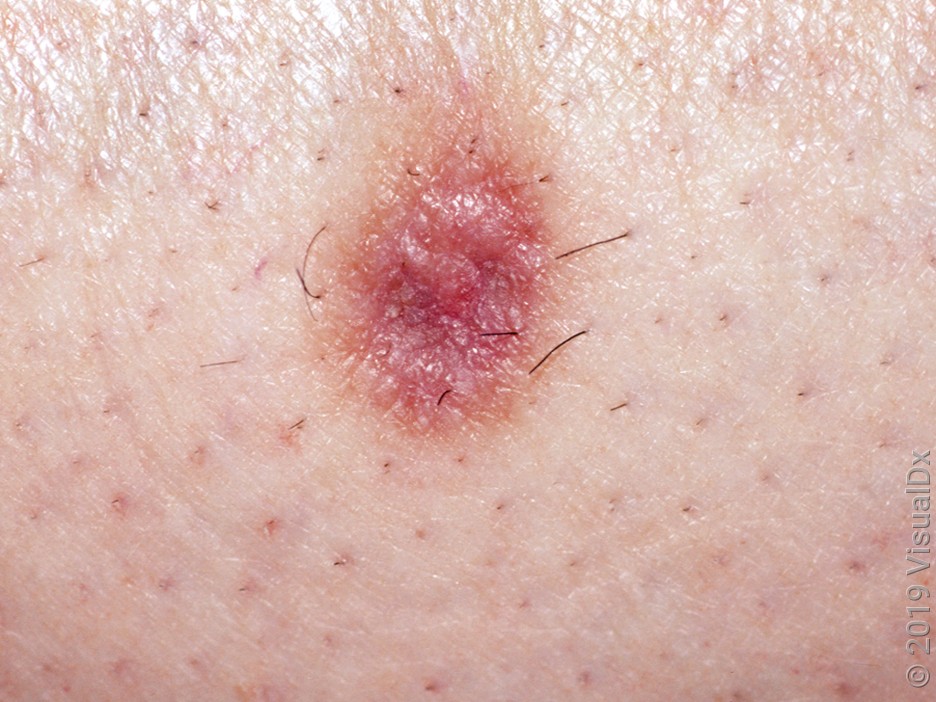 Dermatofibroma on fairer skin.
