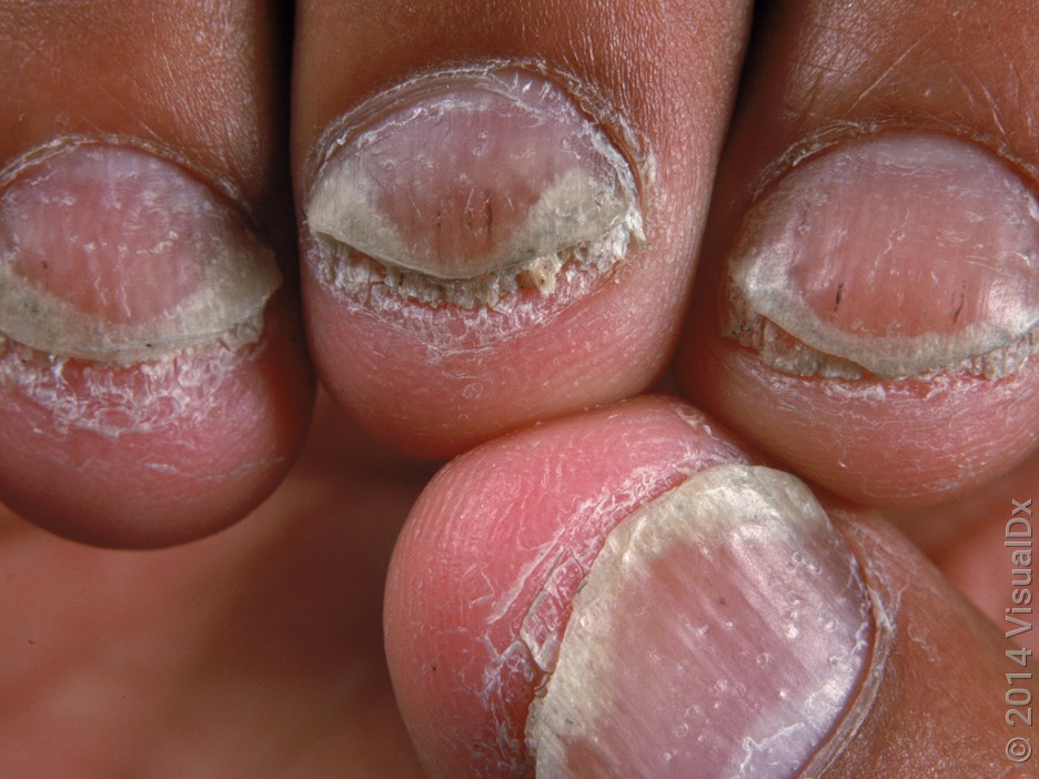 Close-up of short, thick, and discolored fingernails with many tiny pits from psoriasis.