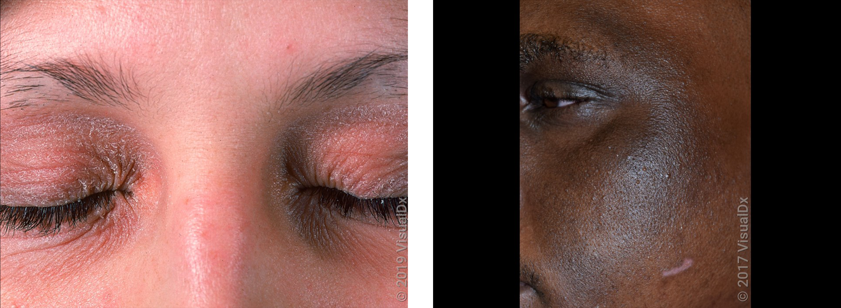 Left: Close-up of closed eyes with red and scaly eyelids. Right: Close-up of cheek with dark brown skin patches (eczema).