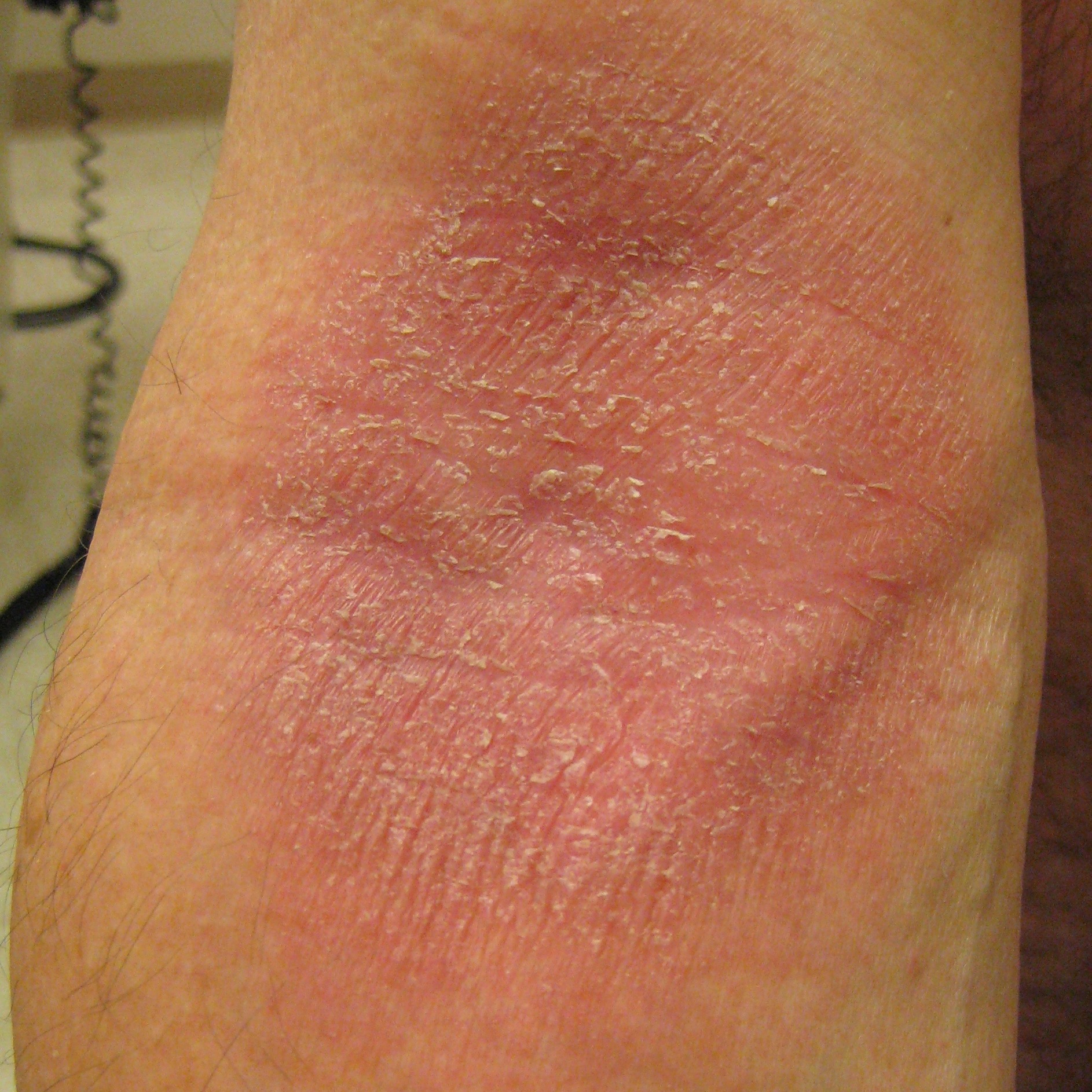 psoriasis on legs only