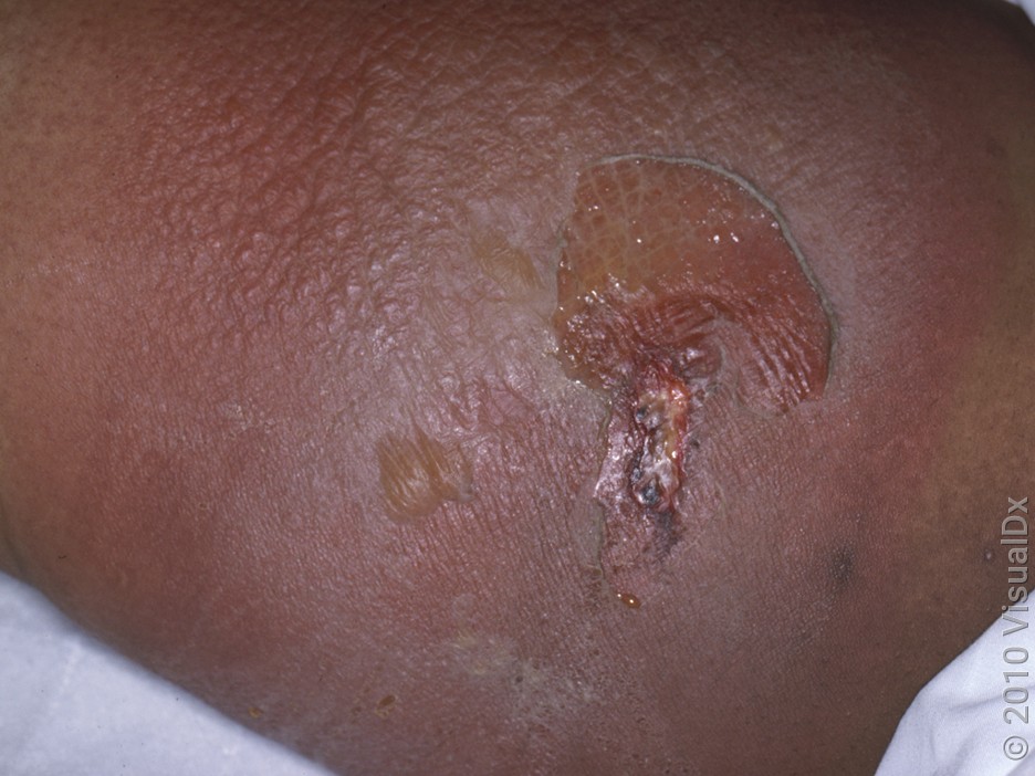 Close-up of skin with blisters and dark red patches from a brown recluse spider bite.
