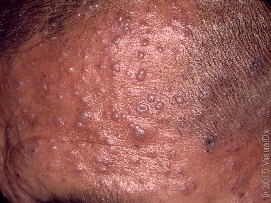 A close-up look at chickenpox on the forehead of an adult. 