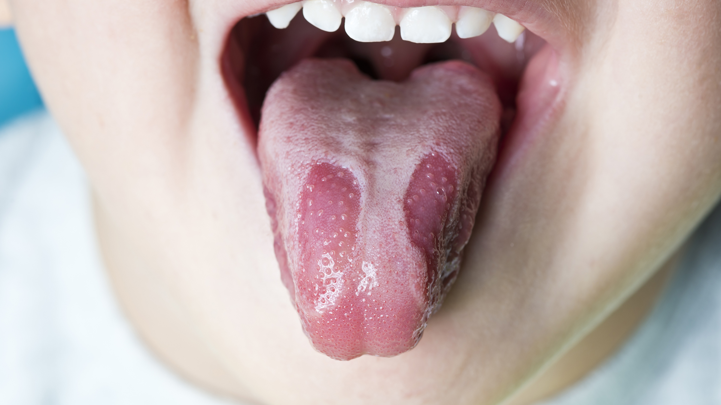 oral herpes under tongue