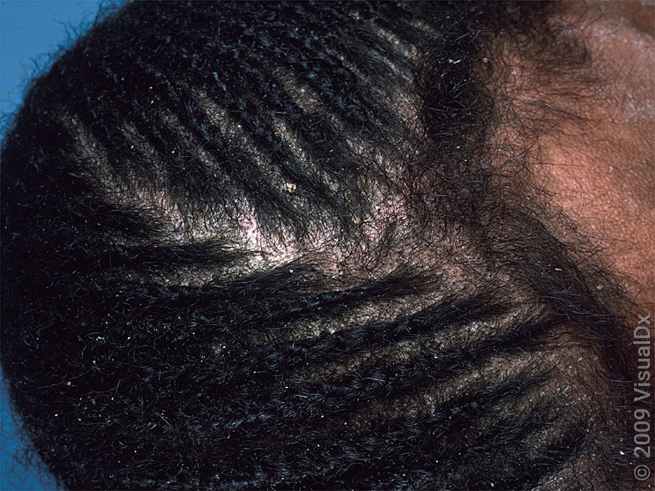 Close-up of greasy flakes on the scalp.