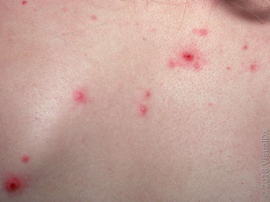 Chickenpox vs. Bug Bites: How to Tell the Difference - GoodRx