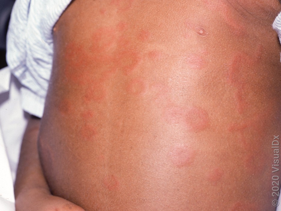 Close-up of infant’s chest with reddish-brown, round, raised patches on the skin caused by hives. 