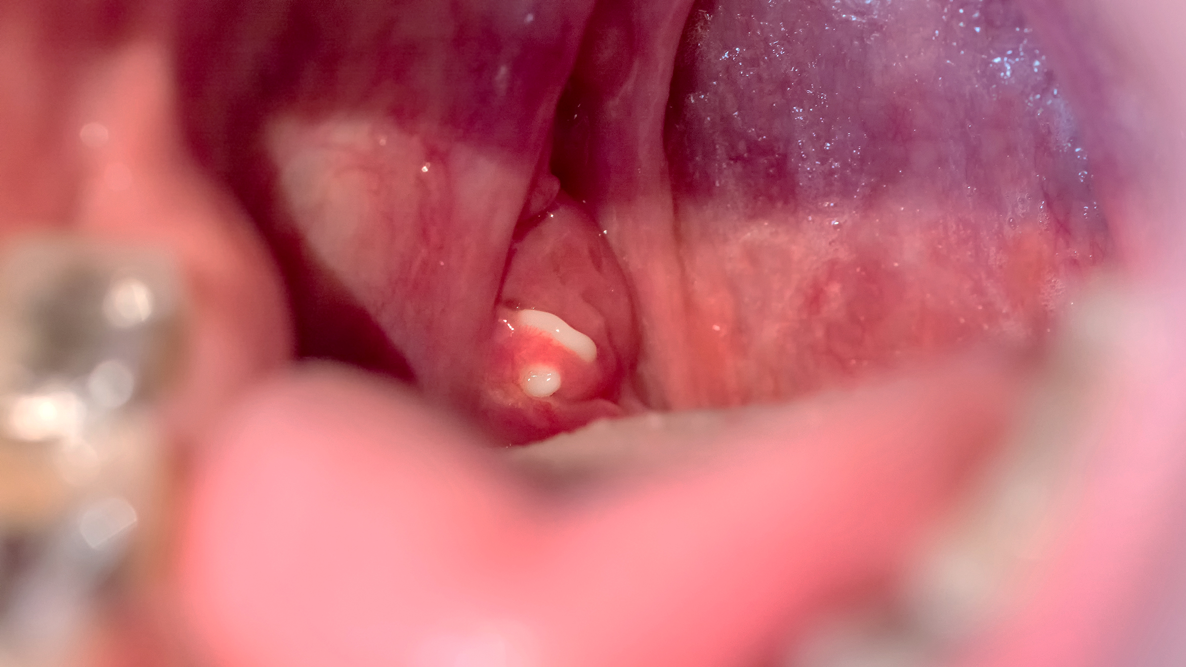 How to Get Rid of Tonsil Stones and Keep Them From Coming Back - GoodRx
