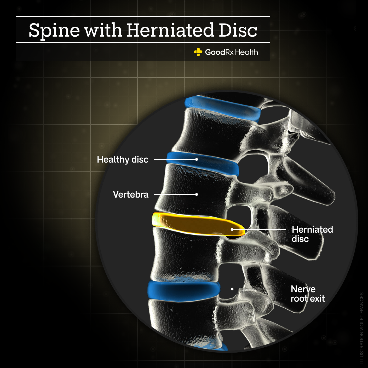 A 3D illustration of a spine with a herniated disc including healthy disc, vertebra, herniated disc, and nerve root exit.