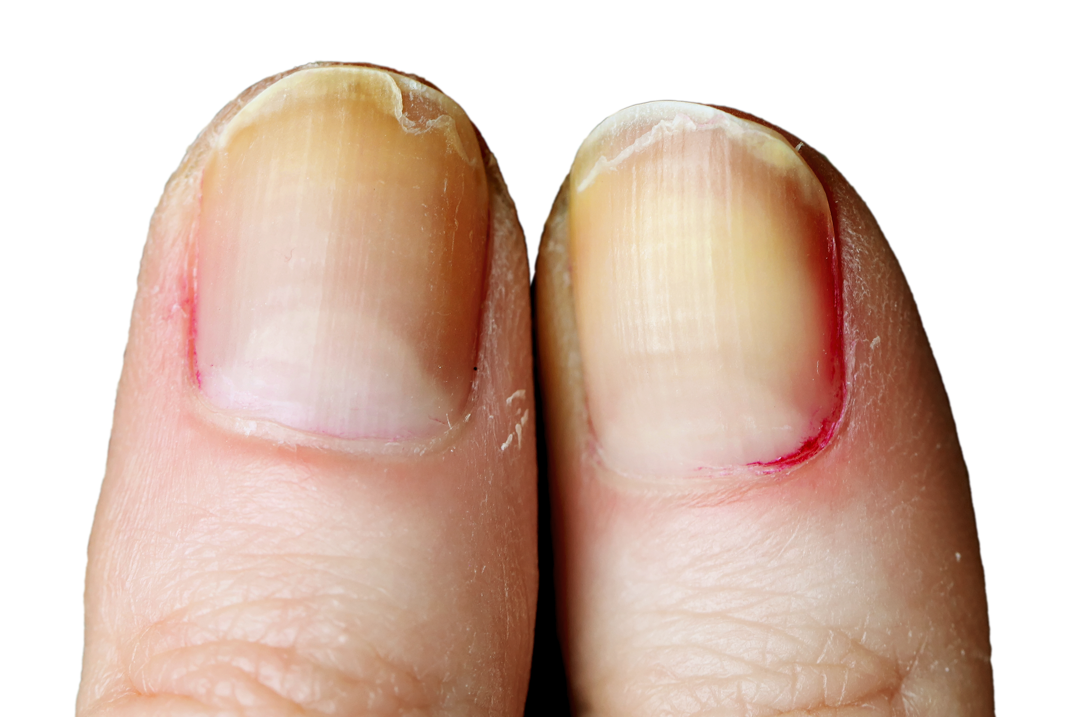 Derm Dx: Discolored toenail - Clinical Advisor