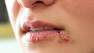 HSV1 Vs HSV2 Differences In Diagnosis Treatment And More GoodRx HSV1 Vs HSV2 Differences In Diagnosis Treatment And More GoodRx