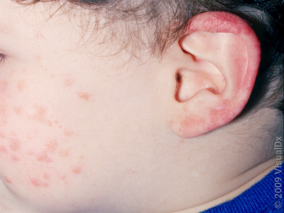 Pink bumps and patches on an infant’s cheek and ear in roseola.