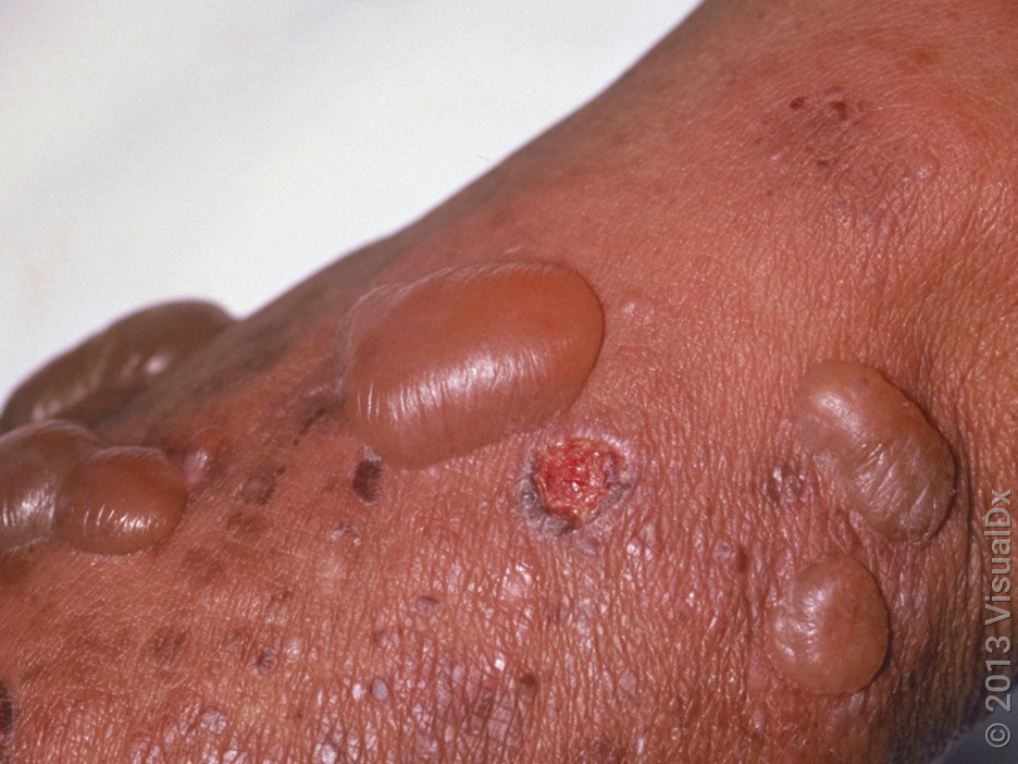 A cluster of fluid-filled blisters. One blister has ruptured. 