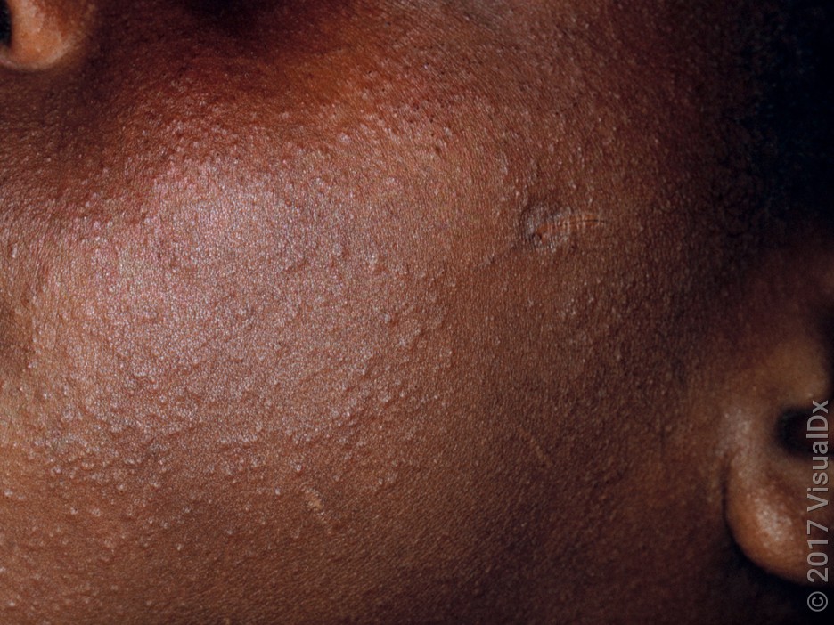 Close-up of a cheek with many tiny, red- and skin-colored bumps on the cheek in miliaria.