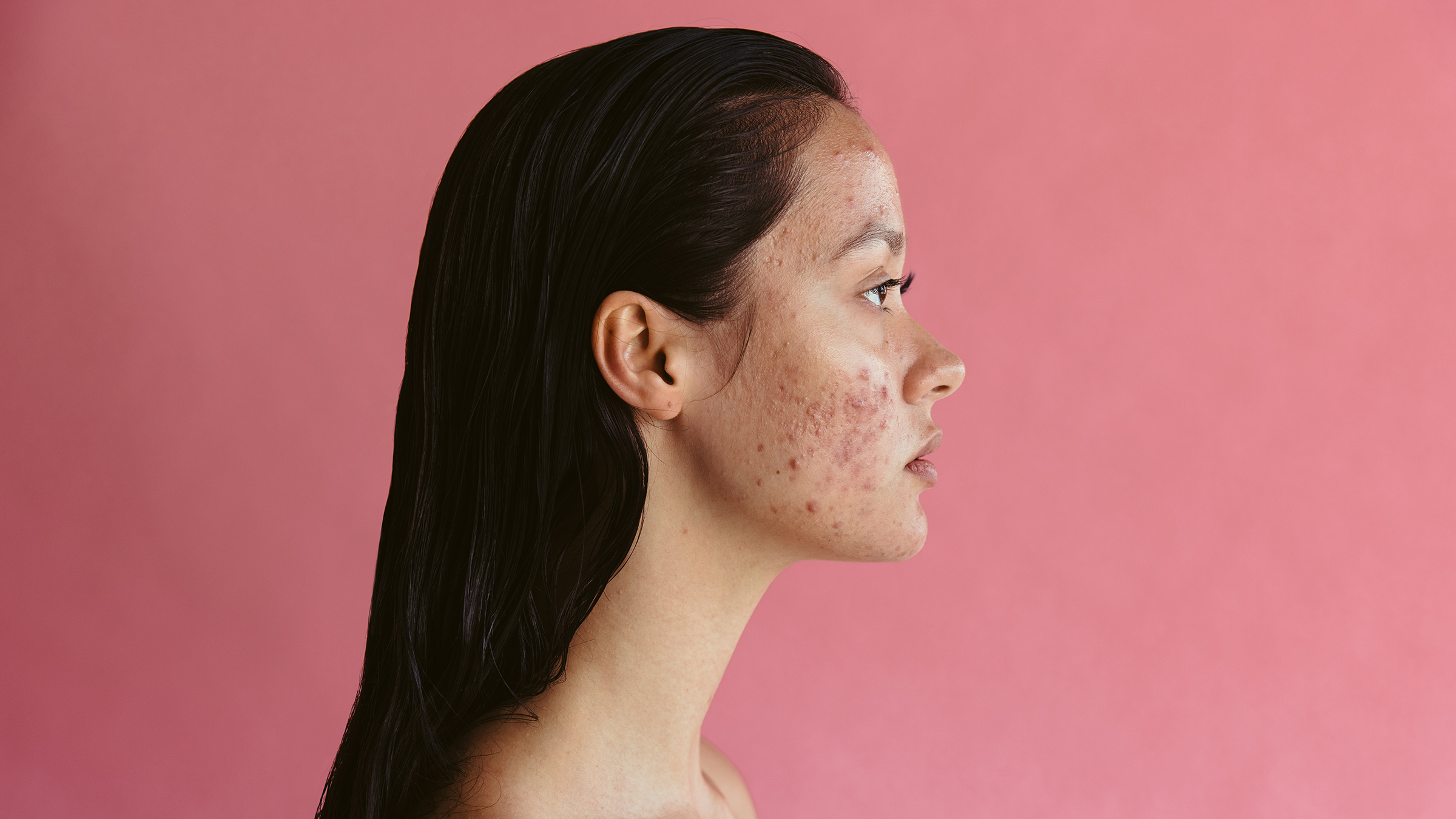 How to Get Rid of Pesky Pimples Fast With These 7 Tips - GoodRx