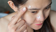 Benzoyl Peroxide Vs Salicylic Acid For Acne Side Effects 