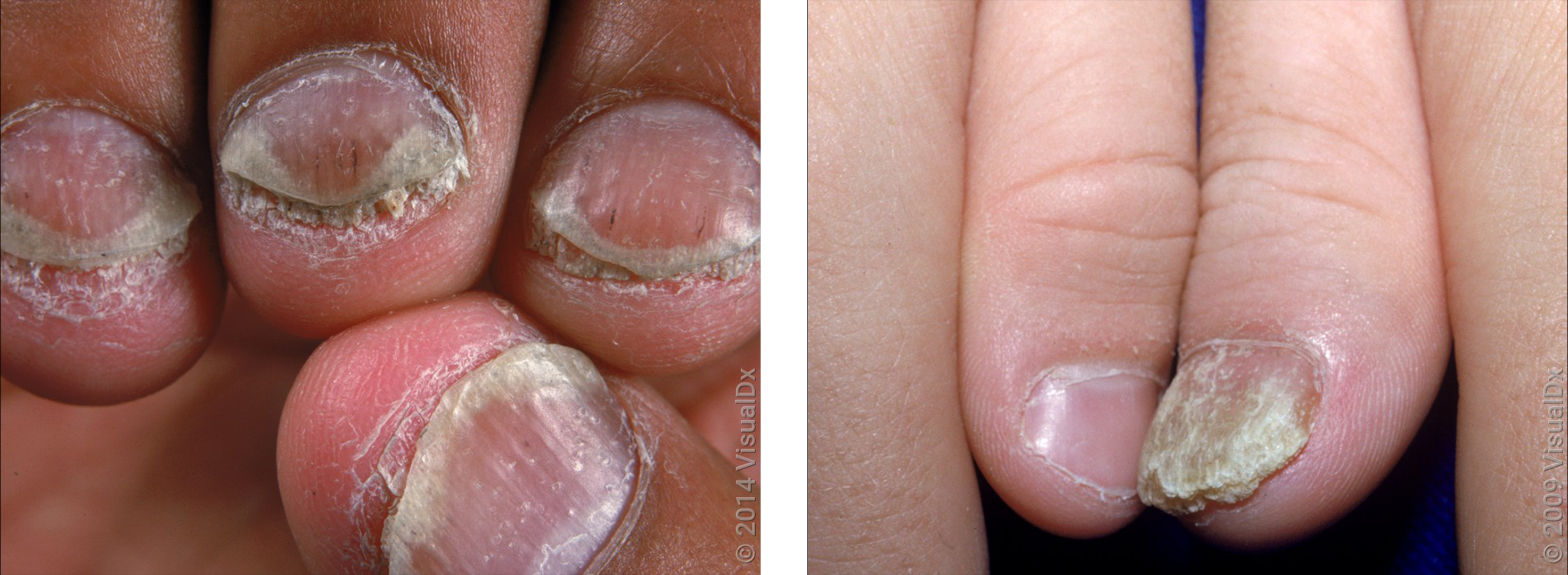Premium Vector | Types of nail psoriasis common nail disorders and diseases