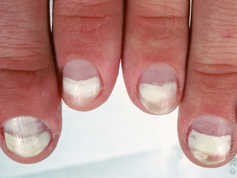 White Mark On Nails : नखांवर पांढरे डाग पडलेत? कॅल्शियम नाहीतर 'हे' आहे  कारण; जाणून घ्या