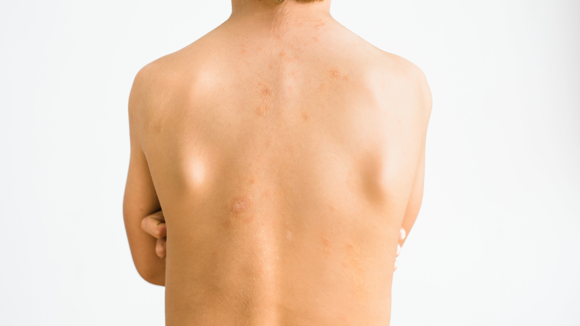 What Is Pityriasis Rosea? This Skin Condition Explained - GoodRx