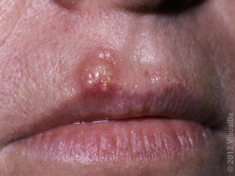 Close-up of a cold sore blister on the lip.
