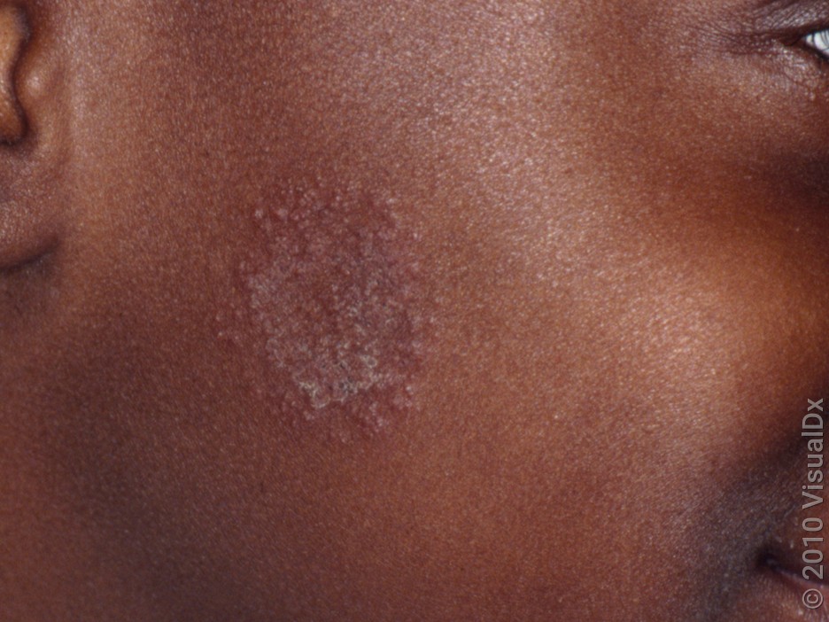 Close-up of ringworm on the face (tinea faceii).