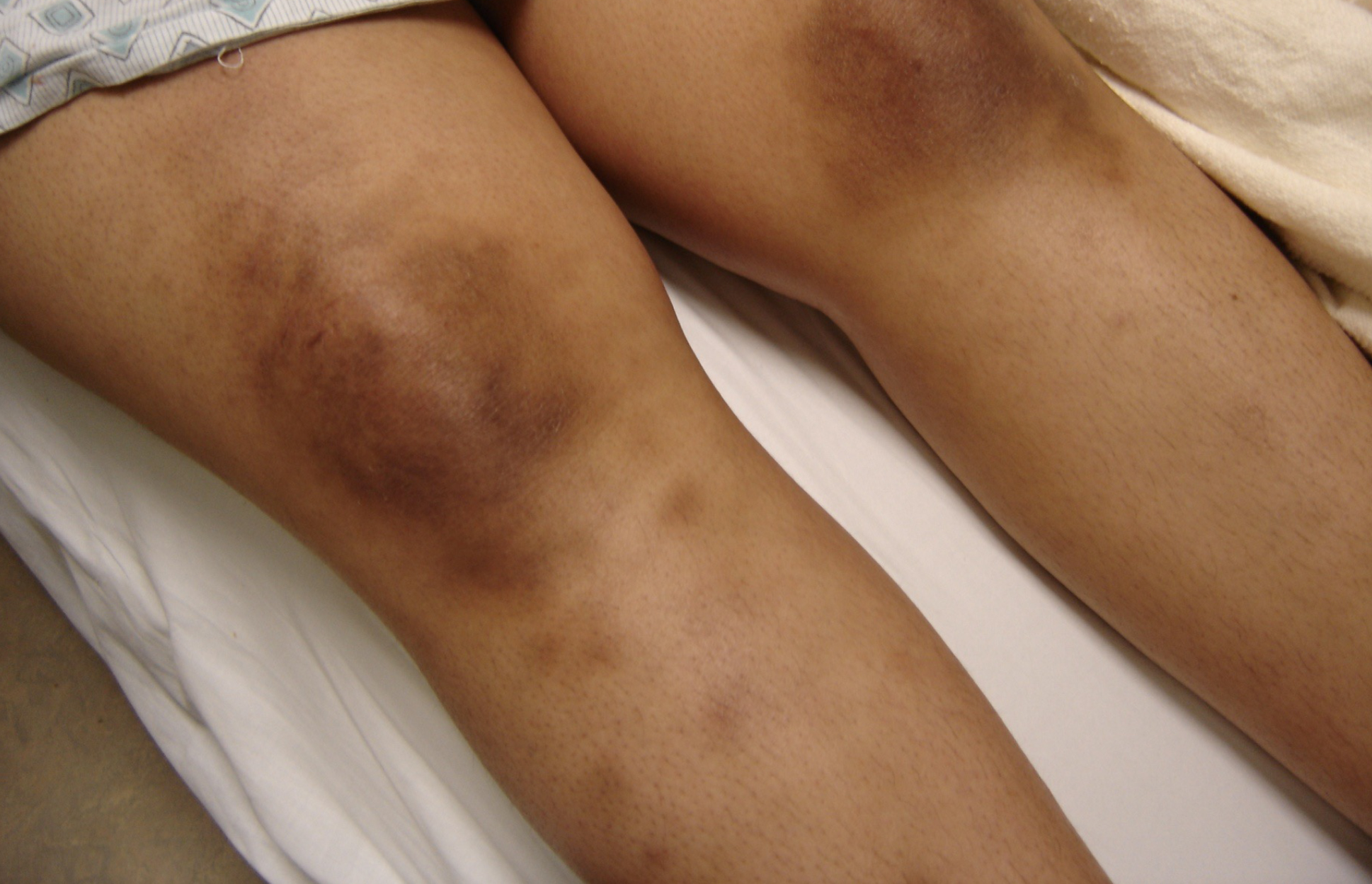 Itchy lupus rash on legs: Pictures, symptoms, and more