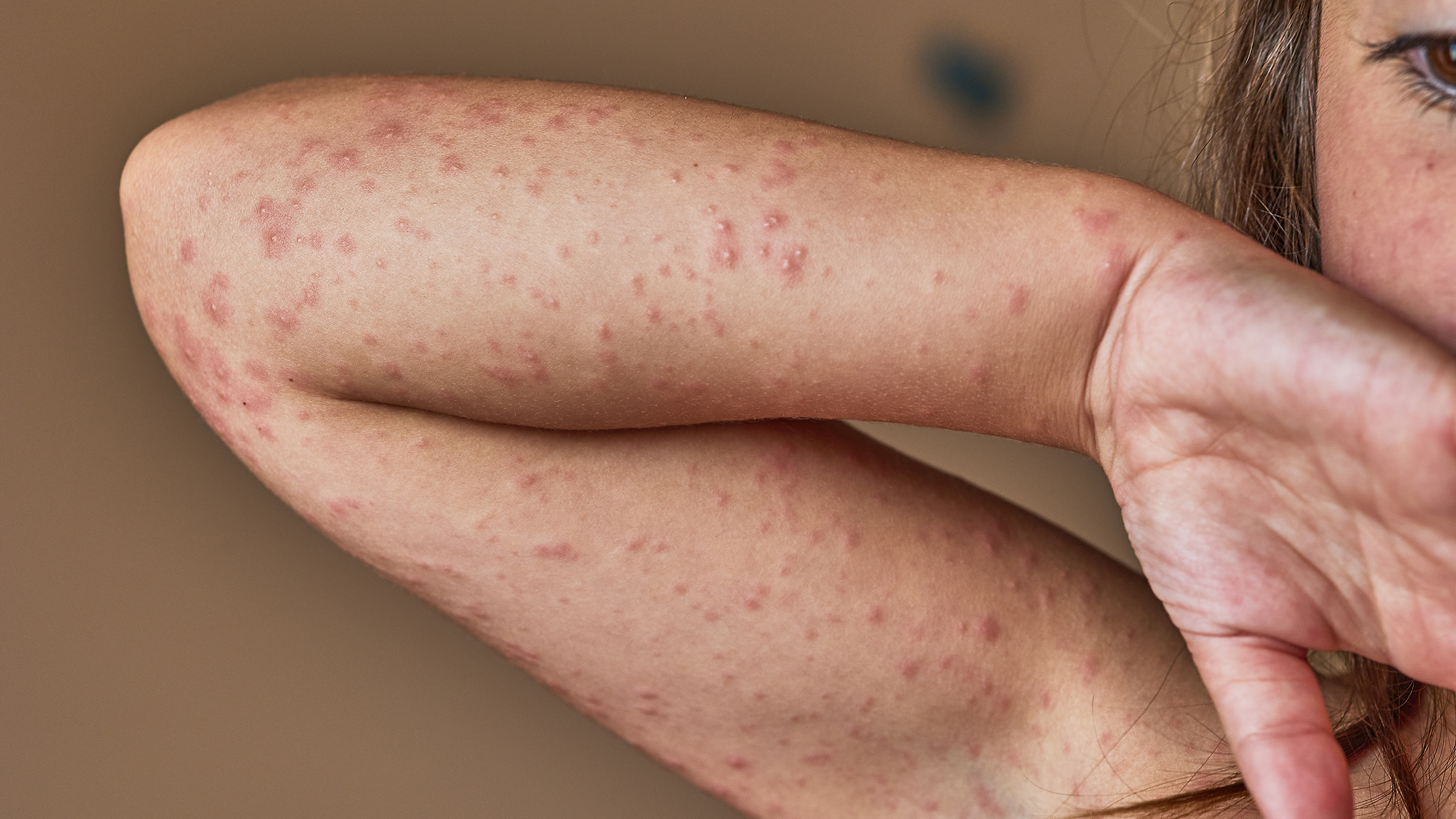 Cropped Womans Arm Allergic Rash 1337085512 