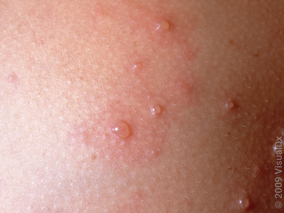 A close-up look at chickenpox blisters. 