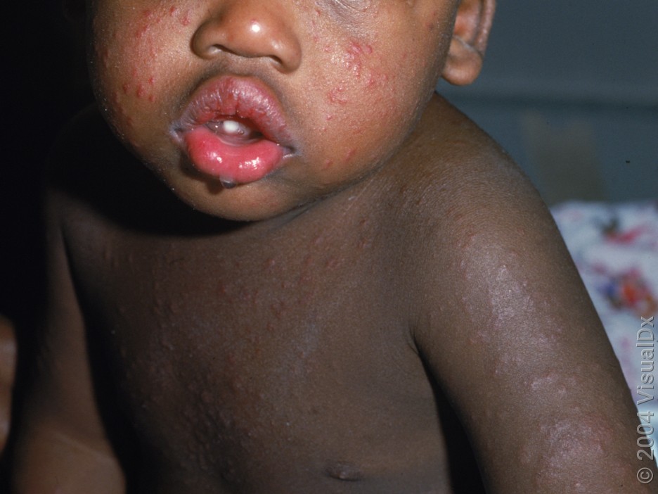 A child with many small, reddish-purple bumps on their cheek, arm, and chest. 