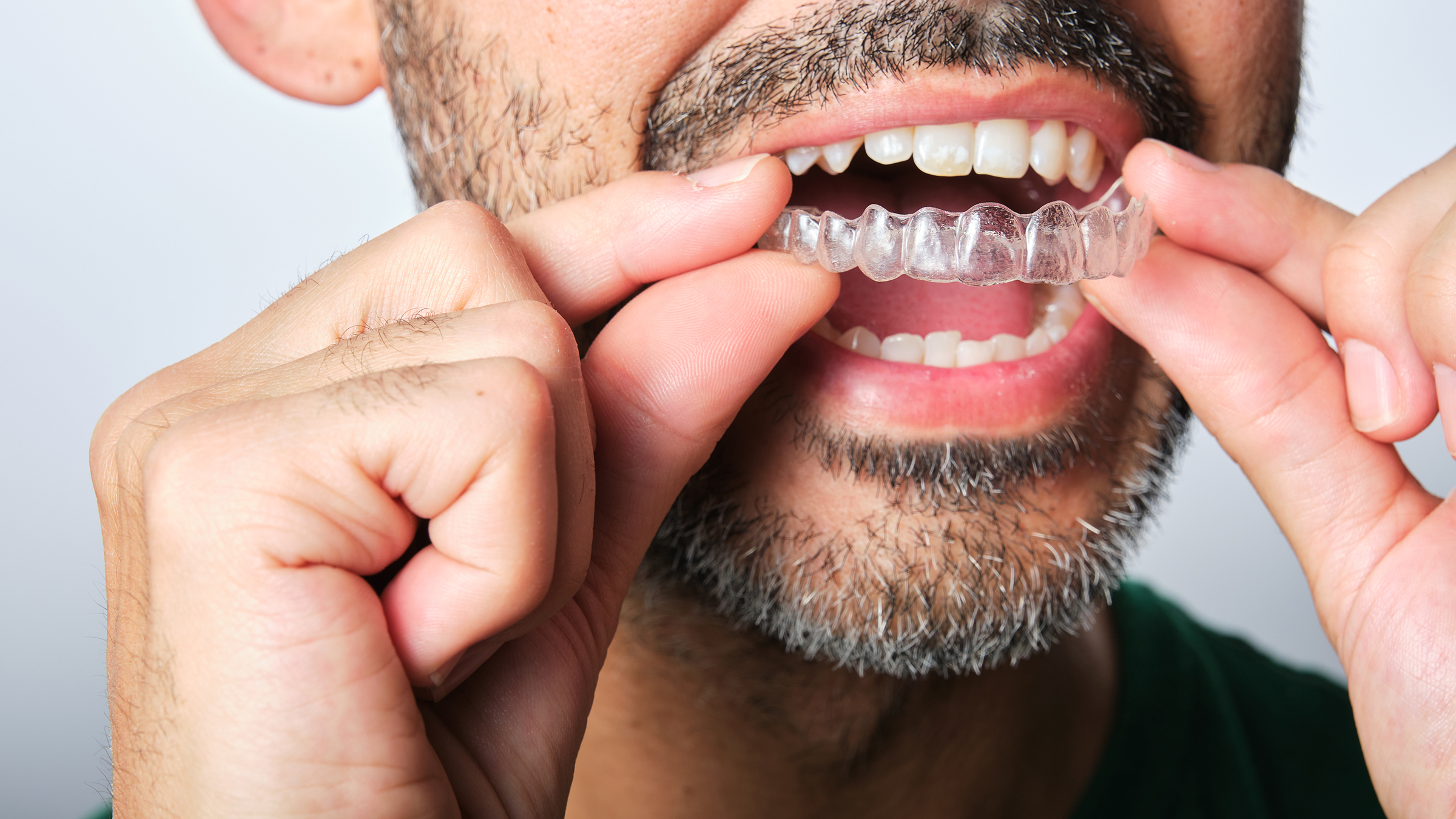 Invisalign vs. Braces: Which Is Better for You? - GoodRx