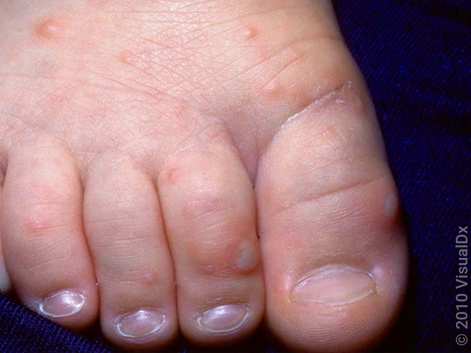 Close-up of an infant’s foot with small, red bumps and white blisters in hand, foot, and mouth disease. 