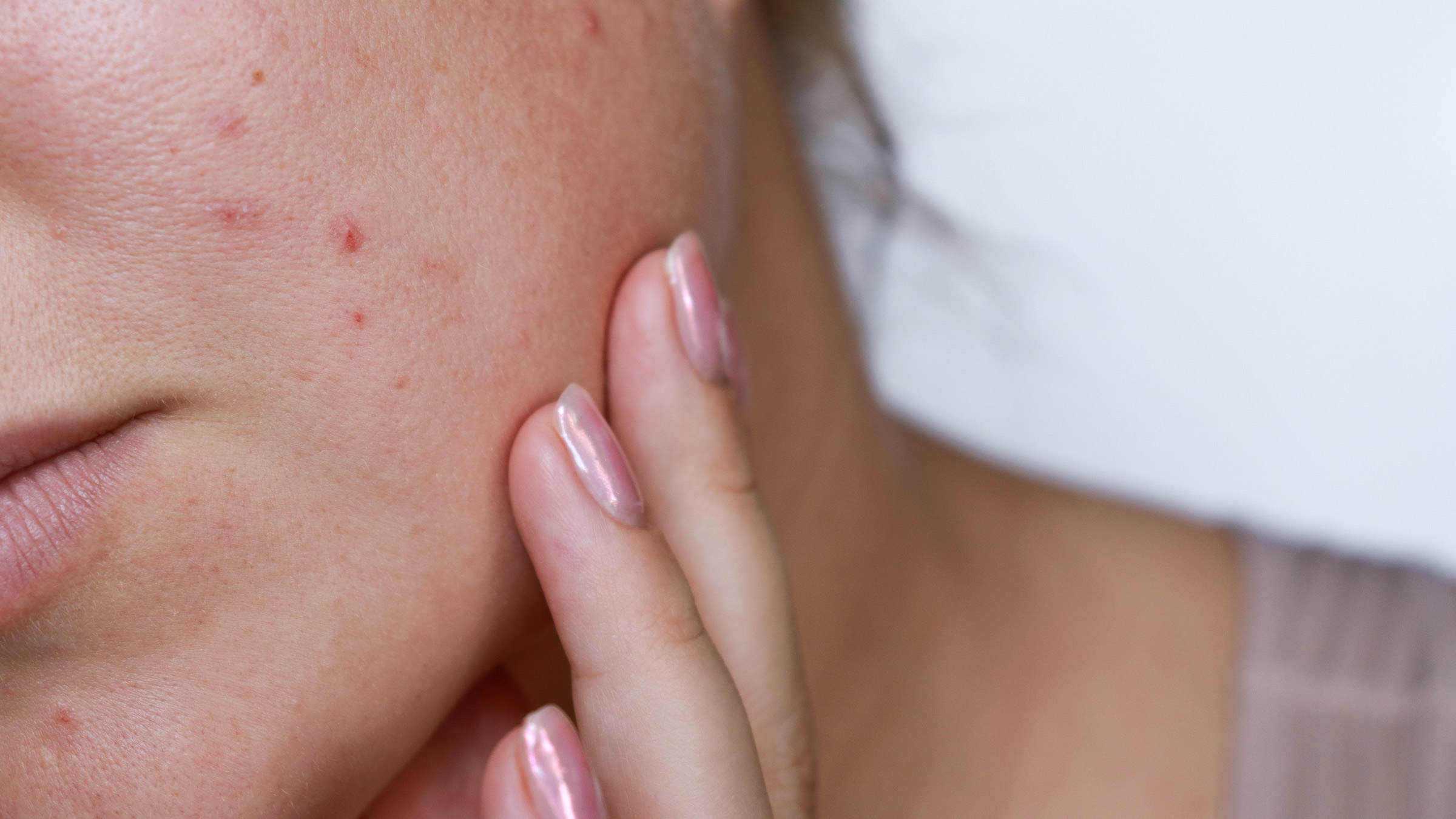 Pregnancy: Acne: close-up face with acne 1438535582