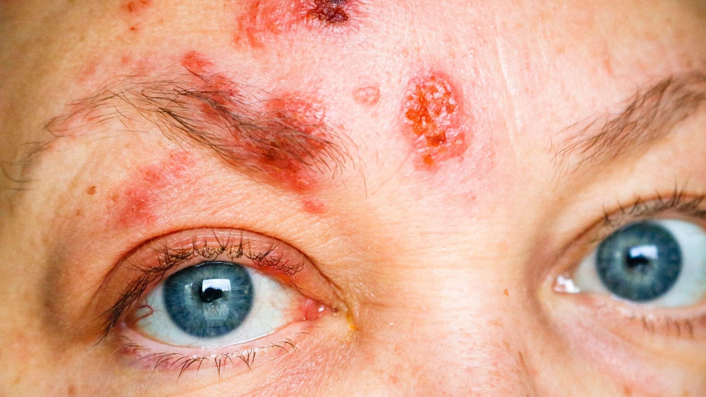 What Causes a Rash the Eye? Do You Treat It? - GoodRx
